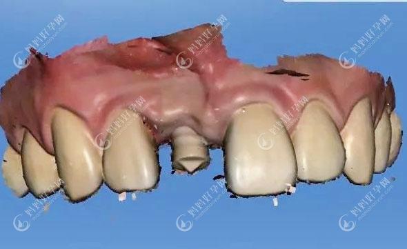 前牙种植方案设计
