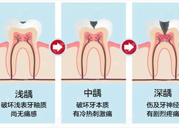 不同程度的龋齿的表现www.mamahaoyun.com