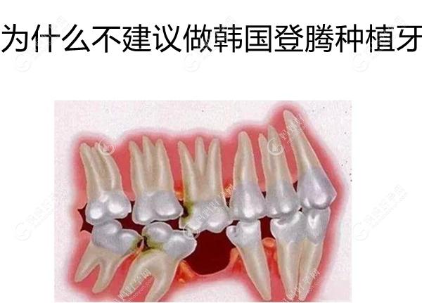 为什么不建议做韩国登腾种植牙,难道是因为登腾种植牙材质?