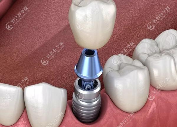 种植牙进入牙骨的过程www.mamahaoyun.com