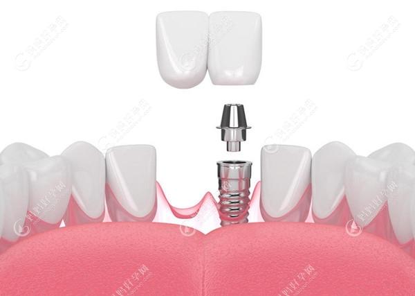 重庆牙卫士口腔医院种植牙优势