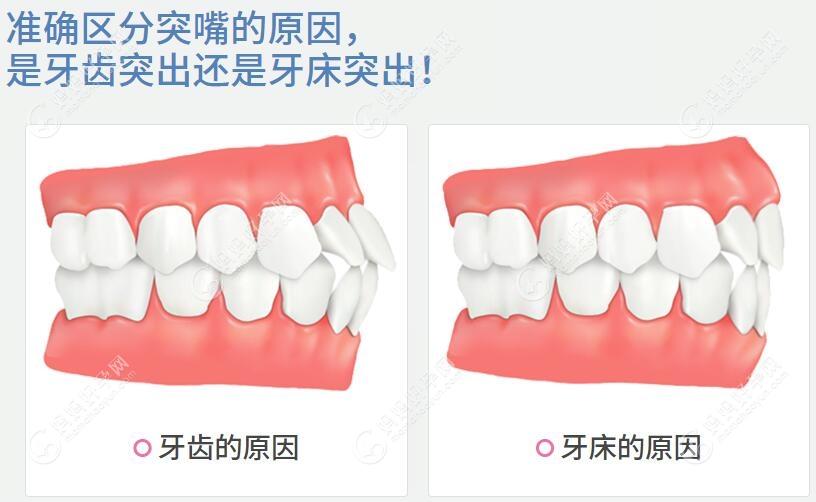 骨性和牙性错颌畸形的区别