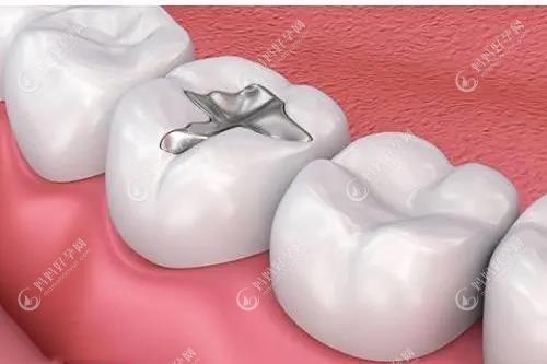 补牙结构示意图