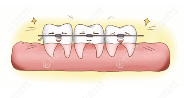 解决门牙牙缝大的三大方法