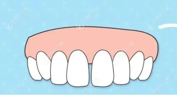 门牙缝隙大的修复办法安排