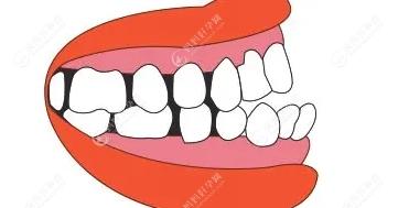 牙缝是因为天生原因较小,建议先做矫正然后在做贴面