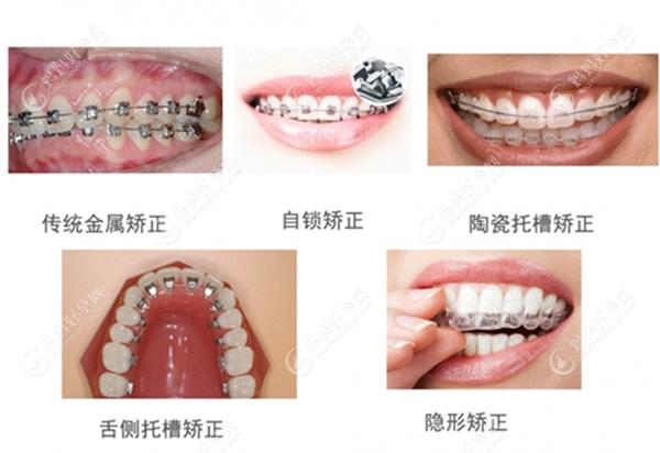 不同类型牙齿矫正器的图片