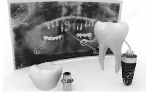 植骨粉的意图在于重建牙齿的骨质