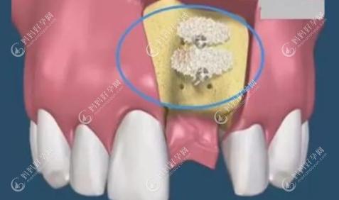 种植牙什么情况下要植骨粉，植完骨粉后多长时间能恢复？