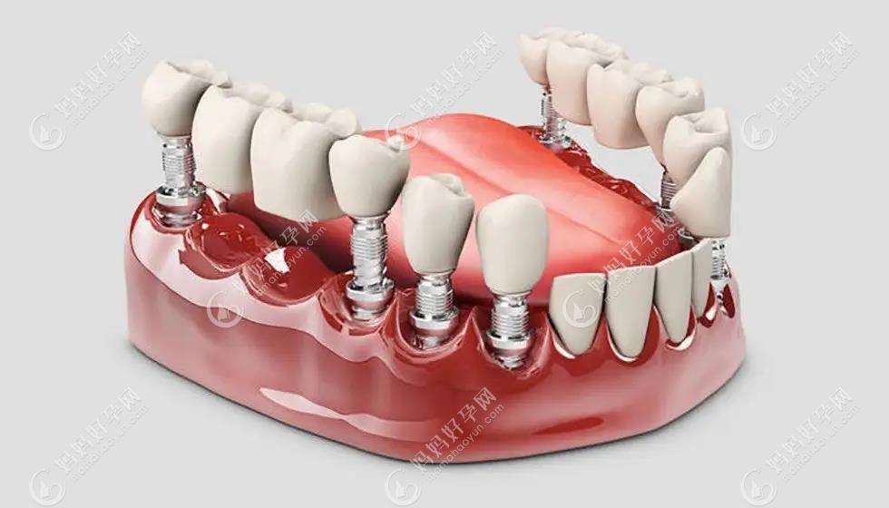 种植牙被誉为人类的第三幅牙齿