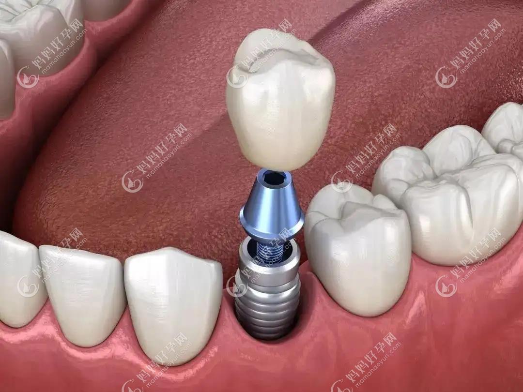 不用磨两边牙的镶牙新技术是无挂钩假牙吗?它的价格贵吗