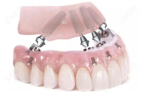 牙医讲解-全口种植牙过程分为几个步骤及种满口牙所需时间