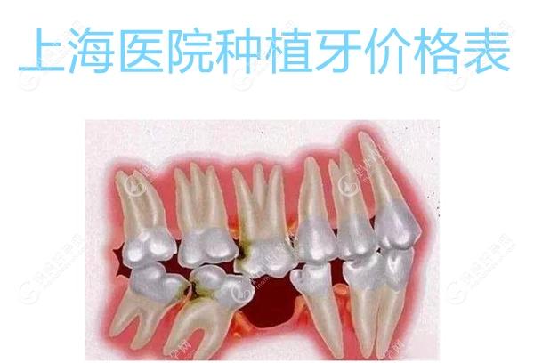 上海医院种植牙价格表:韩国进口种植牙4980元起,德国5999元起