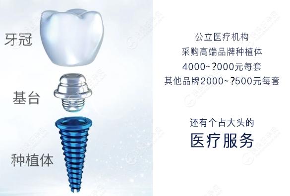 民营牙科的种植牙的集采价格直接低至1800-3500元一颗