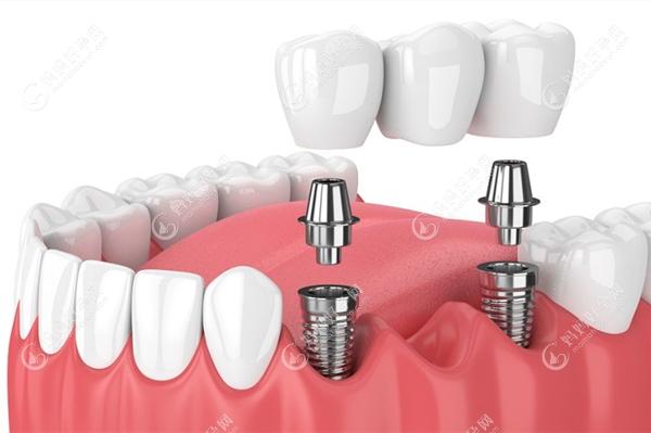 牙槽骨条件对种牙的要求