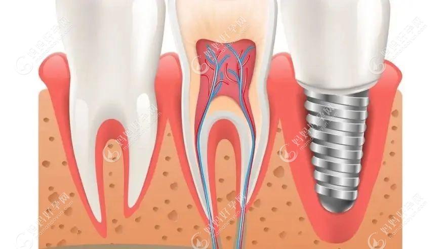 牙槽骨的骨质对种植牙的成活也有影响