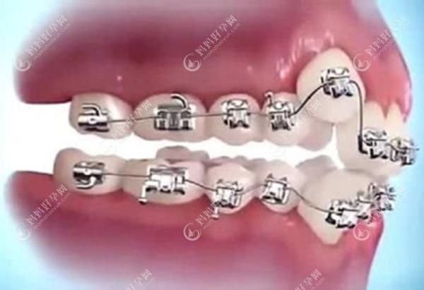 金属矫正牙齿的图