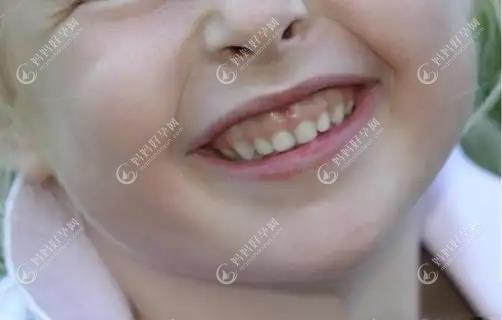 小朋友笑起来露牙龈怎么办?儿童一笑牙龈就外露能矫正吗