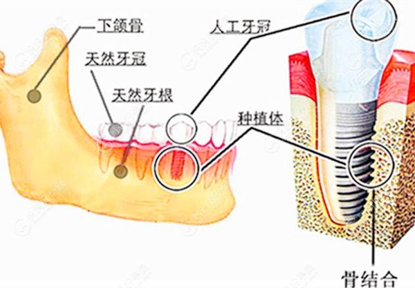 种植牙在牙槽骨内的图m.mamahaoyun.com