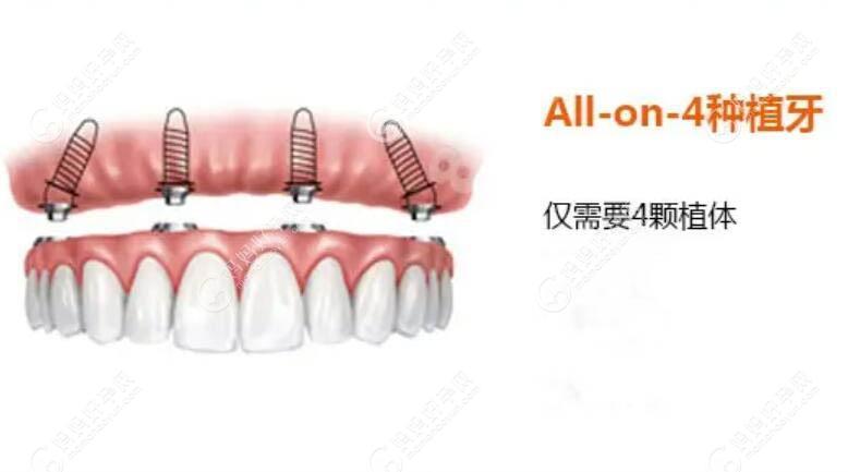all-on-4种植牙方式