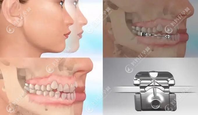 牙槽骨薄可以做牙齿矫正吗,真会造成正畸骨裂开或失败吗？