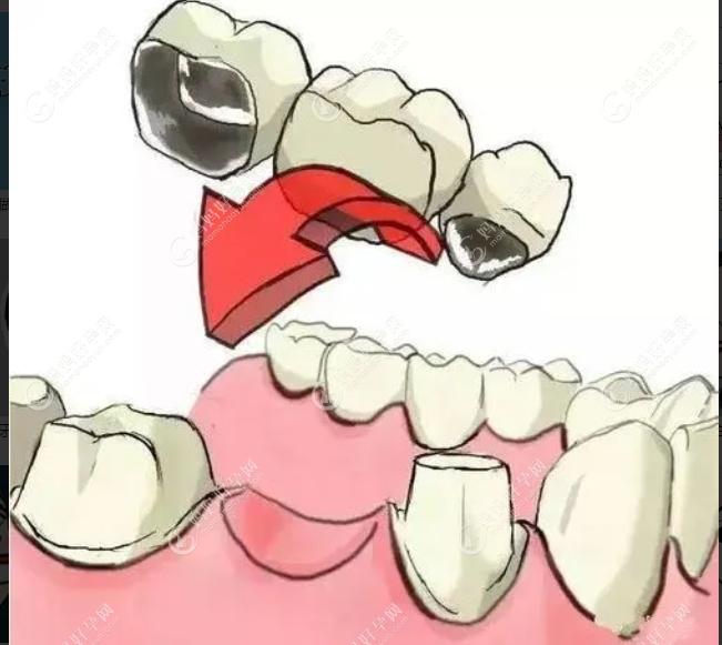 牙冠安装图片www.mamahaoyun.com
