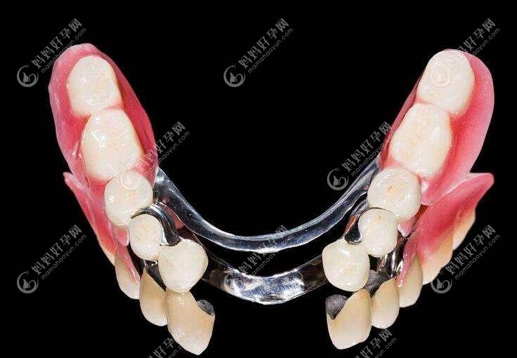 牙齿缺失修复方法,含固定义齿,活动义齿,种植牙优缺点