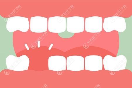 牙齿缺失修复方法