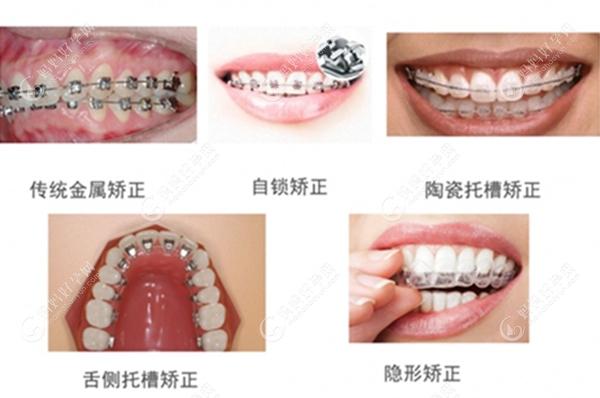 牙齿矫正器的类型m.mamahaoyun.com