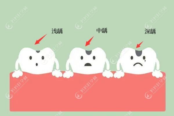 浅龋、中龋补牙治疗，深龋牙髓炎可以直接补牙吗？