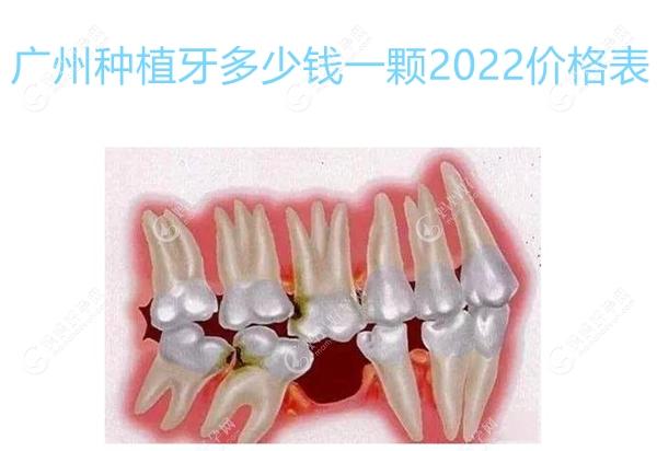 广州种植牙多少钱一颗2022价格表