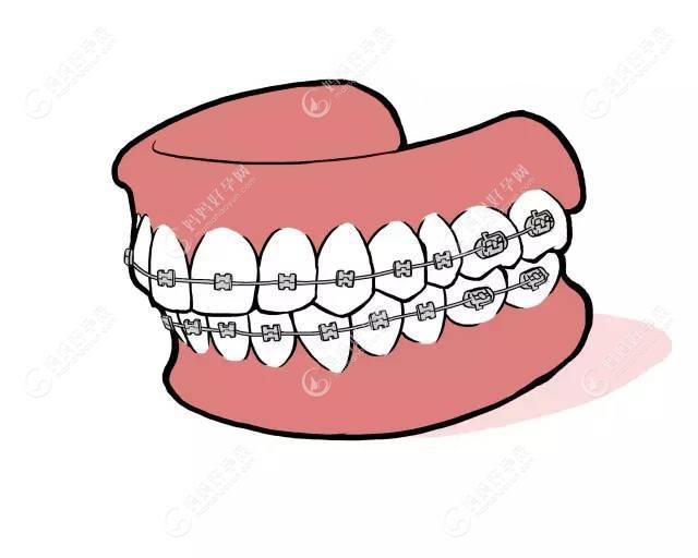 金属牙套和陶瓷牙套的区别，为什么医生不推荐陶瓷牙套？