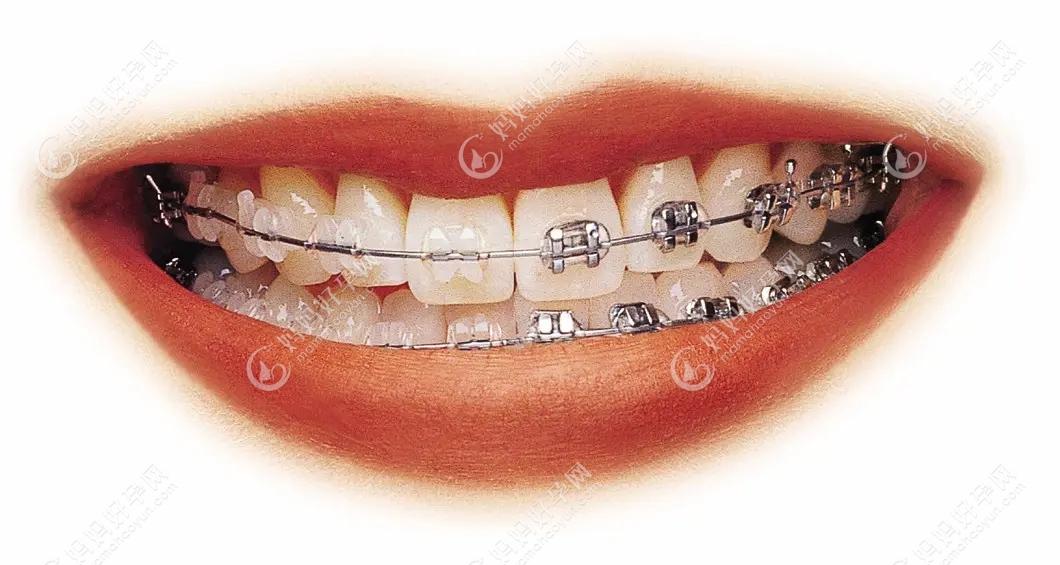 金属牙套和陶瓷牙套的区别.jpg