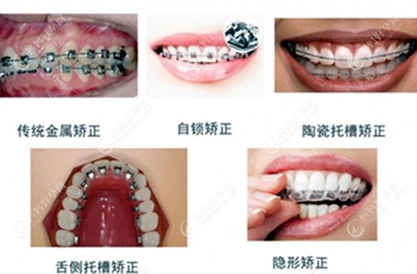 牙齿矫正器的各种类型m.mamahaoyun.com