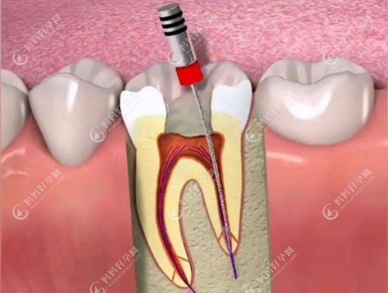 牙根短有什么补救办法吗？