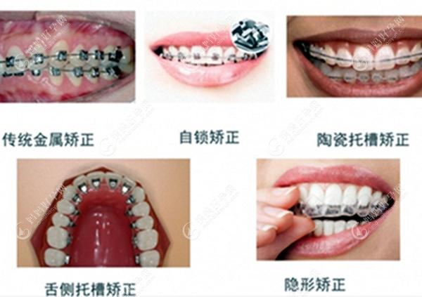 牙齿矫正器的类型图www.mamahaoyun.com