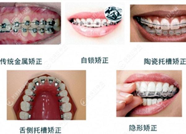 牙齿矫正器的类型www.mamahaoyun.com