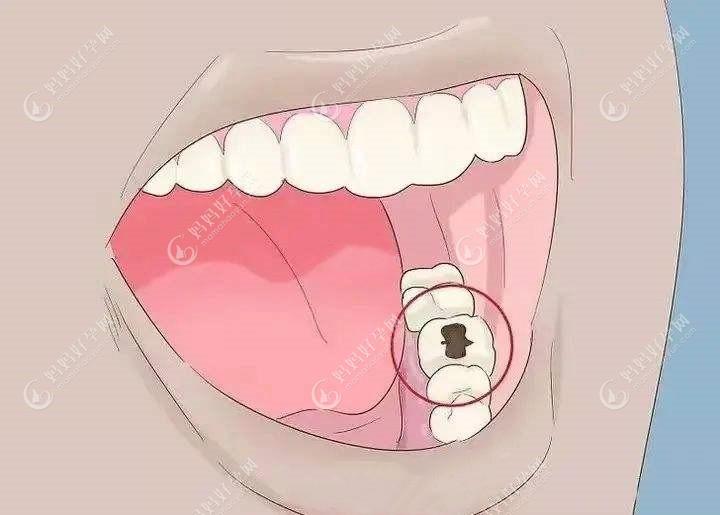 牙齿烂洞长期不补会怎样？www.mamahaoyun.com
