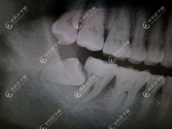 智齿没有咬合的牙会长到什么程度www.mamahaoyun.com