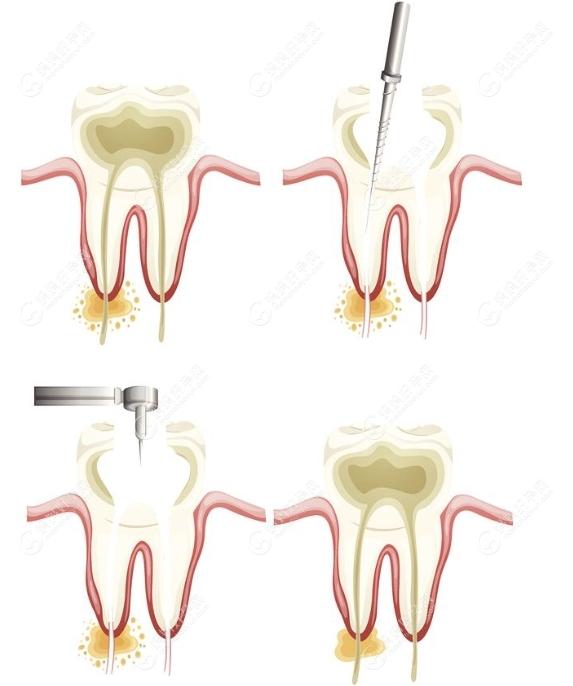 牙髓炎根管治疗方法www.mamahaoyun.com