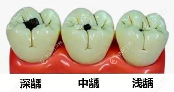 龋齿怎么补牙？3种补牙方法，推荐填充、嵌体