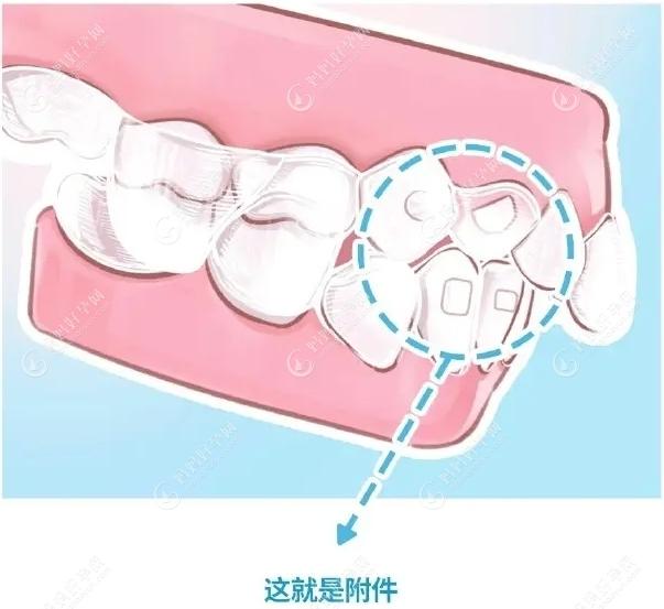隐形牙套上的小附件mamahaoyun.com