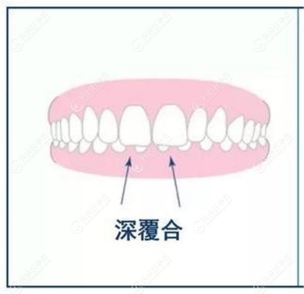 如何判断深覆合骨性还是牙性？深覆合是骨性一定要手术吗？.jpg.www.mamahaoyun.com