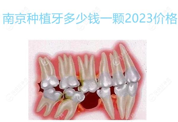 南京种植牙多少钱一颗2023年价格:单颗种牙2700起,全口10.8万起