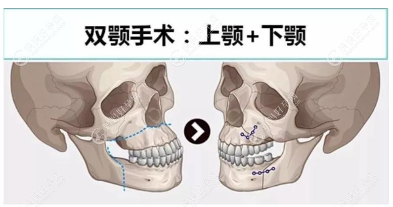 双鄂正颌手术过程图解