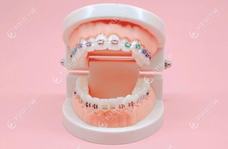 牙齿矫正的4种类型mamahaoyun.com
