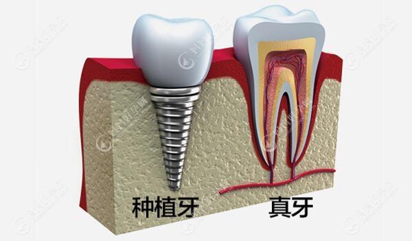 影响种植牙使用寿命的因素mamahaoyun.com