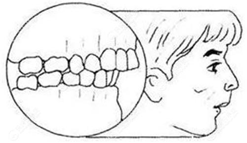 上颌前突的位置在上牙槽骨