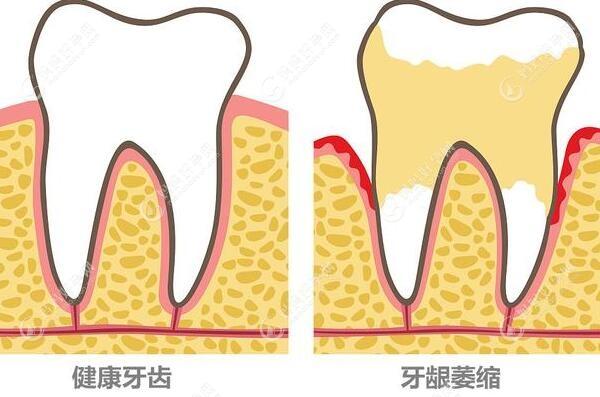 健康牙齿和牙龈萎缩对比图mamahaoyun.com