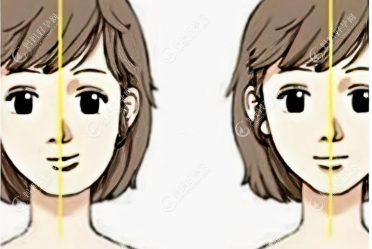 正颌手术前后脸型改变图片mamahaoyun.com